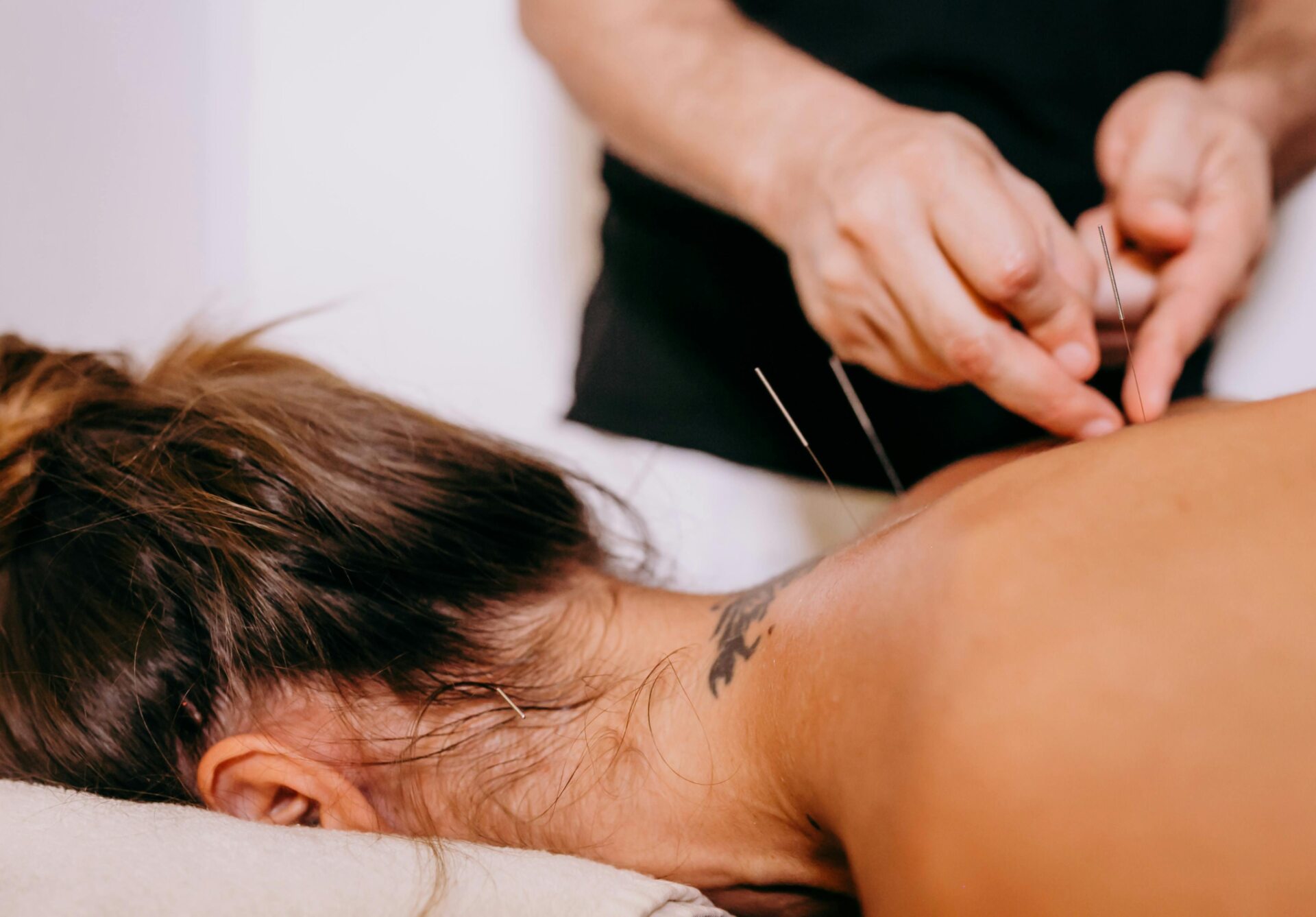 Dry Needling
